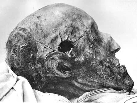 Carl XII of Sweden - Autopsy of Charles XII of Sweden in 1917