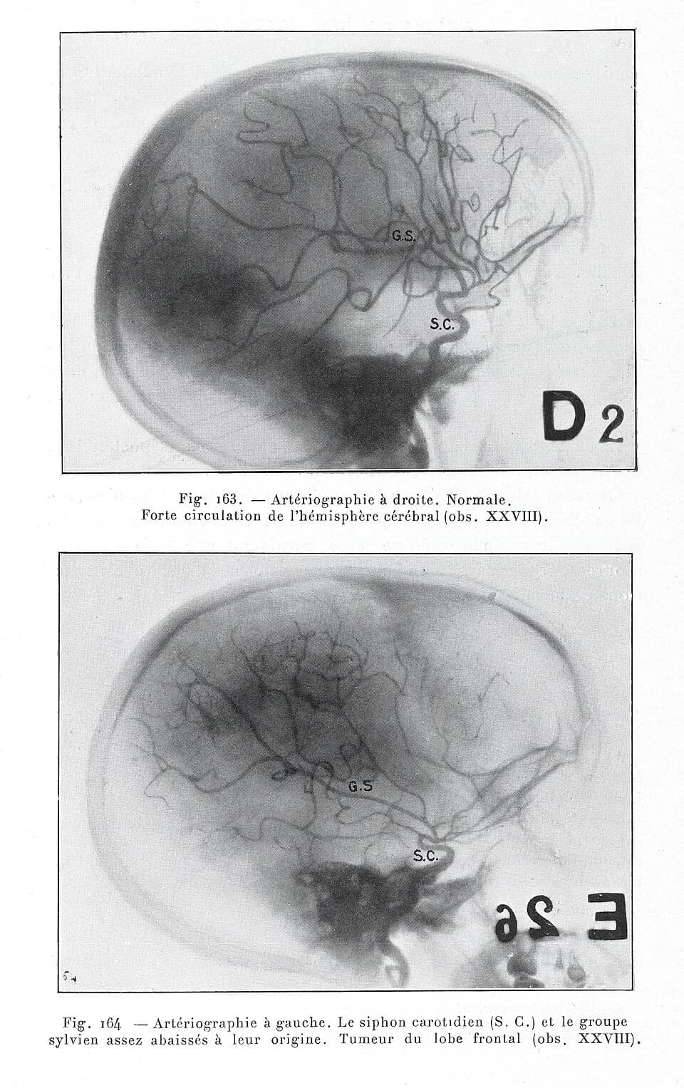 António Egas Moniz - fig 163 - Arteriographie a droite. Normale. Forte circulation de l'hemisphere cerebral (obs xxv111).
fig 164 - Arteriographie a gauche. Le siphon carotidien (S.C) et le groupe syl