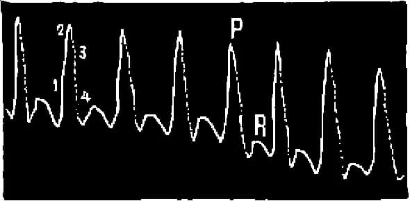 Alfred Binet - graphique du pouls de l’artère radiale