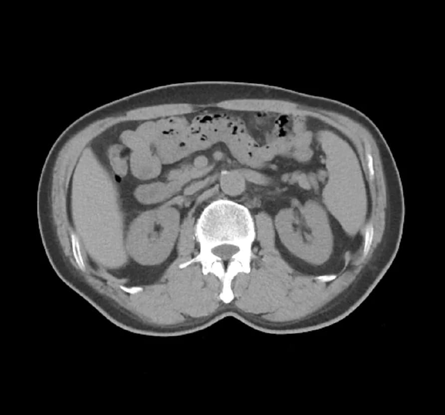 Godfrey Hounsfield - One frame of a CT scan of the abdomen. This image is for general illustration purposes only.